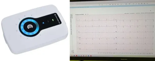 EKG – elektrokardiogram