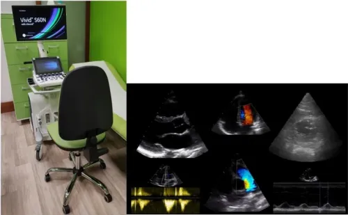 Echokardiografie (ultrazvuk srdce)